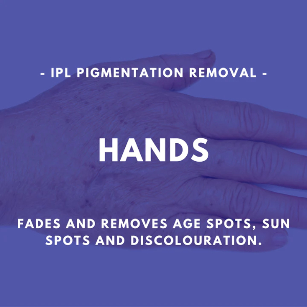 Hands - IPL Pigmentation Removal