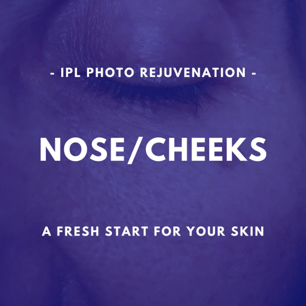 Nose/Cheeks - IPL Photo Rejuvenation